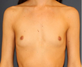 Feel Beautiful - Natural Breast Augmentation 013 - Before Photo
